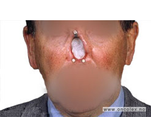 Foto, kreft i nese, bihuler. Amputert nese.