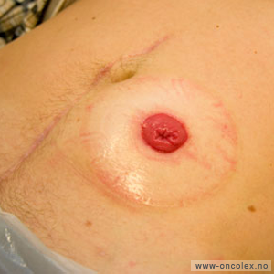 Føflekk med ujevn farge og sorte partier. 