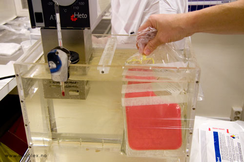 HMAS. Slik utføres tilbakeføring av stamceller, ved kreftbehandling.