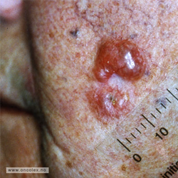 Før fotodynamisk behandling