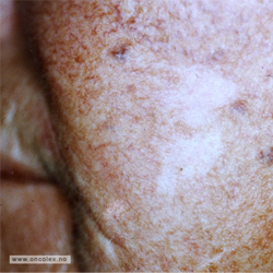 Etter fotodynamisk behandling