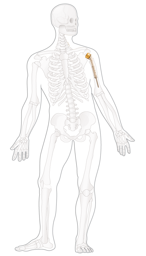 Illustrasjon Kreftlex, sarkom, kirurgi, skulderprotese