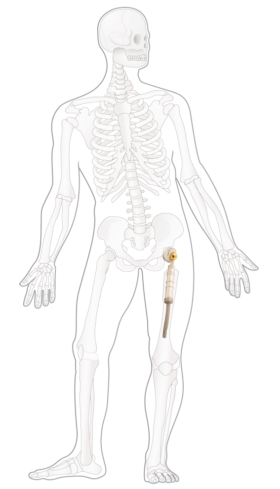 Illustrasjon Kreftlex, sarkom, kirurgi, lårprotese