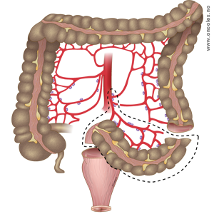 illustrasjon tykktarm Hartmann inndeling