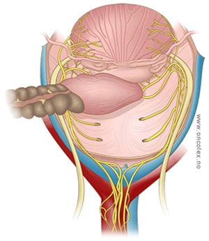 Illustrasjon overgang tarm til bekken. Kirurgi ved tykktarmskreft.