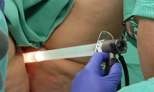 Rektoskopi, slik utføres undersøkelse av endetarmen