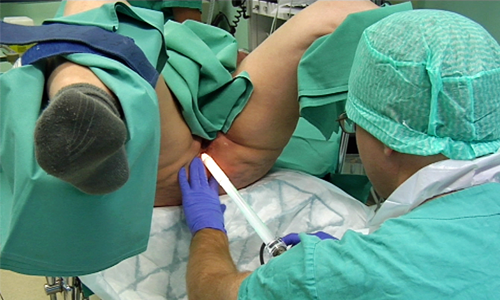 Rektoskopi, slik utføres undersøkelse av endetarmen